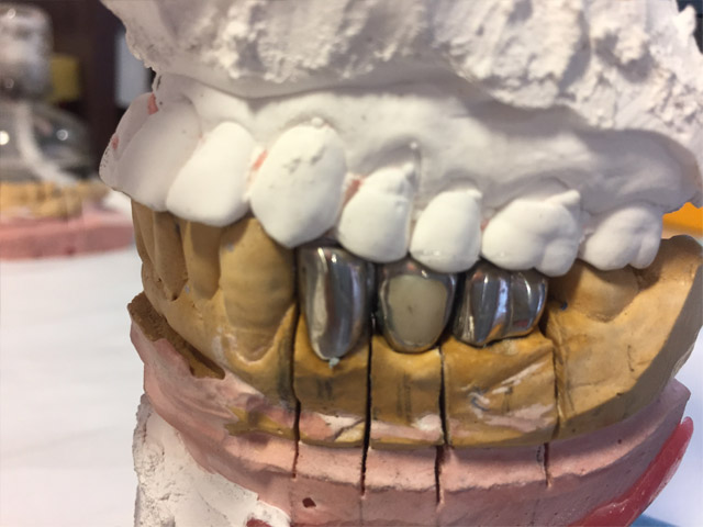 金属アレルギーとお口の中の金属の歯